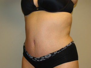 Tummy Tuck Before and After 93 | Sanjay Grover MD FACS