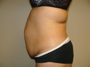 Tummy Tuck Before and After 93 | Sanjay Grover MD FACS