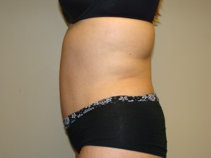 Tummy Tuck Before and After 93 | Sanjay Grover MD FACS