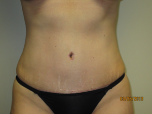 Tummy Tuck Before and After | Grover Aesthetics