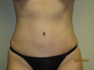 Tummy Tuck Before and After | Sanjay Grover MD FACS