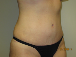 Tummy Tuck Before and After 94 | Sanjay Grover MD FACS