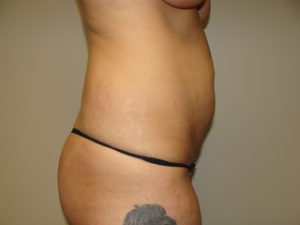 Tummy Tuck Before and After 94 | Grover Aesthetics