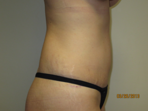 Tummy Tuck Before and After 94 | Grover Aesthetics