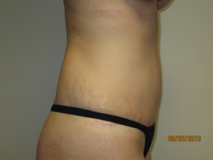 Tummy Tuck Before and After 94 | Sanjay Grover MD FACS