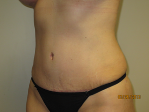 Tummy Tuck Before and After 94 | Grover Aesthetics