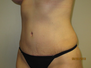 Tummy Tuck Before and After 94 | Sanjay Grover MD FACS