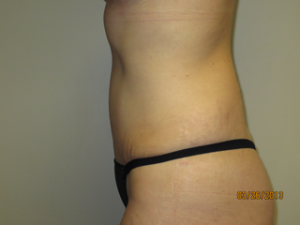 Tummy Tuck Before and After 94 | Grover Aesthetics
