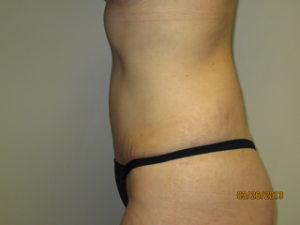 Tummy Tuck Before and After 94 | Sanjay Grover MD FACS