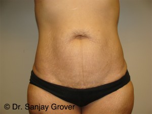 Tummy Tuck Before and After | Grover Aesthetics