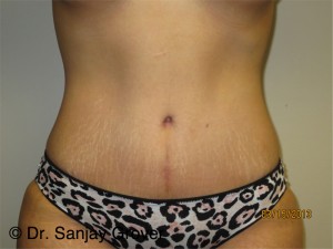 Tummy Tuck Before and After | Grover Aesthetics