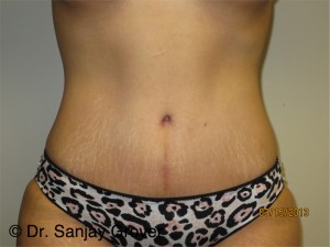 Tummy Tuck Before and After 95 | Sanjay Grover MD FACS