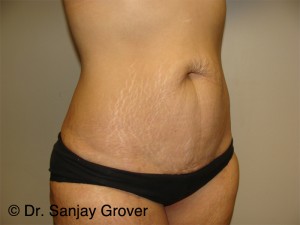 Tummy Tuck Before and After 95 | Sanjay Grover MD FACS