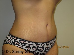 Tummy Tuck Before and After 95 | Sanjay Grover MD FACS