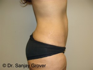 Tummy Tuck Before and After 95 | Grover Aesthetics