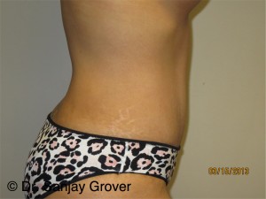 Tummy Tuck Before and After 95 | Grover Aesthetics