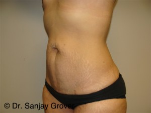 Tummy Tuck Before and After 95 | Grover Aesthetics