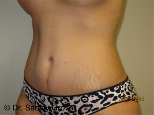 Tummy Tuck Before and After 95 | Grover Aesthetics