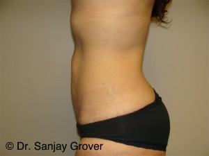 Tummy Tuck Before and After 95 | Grover Aesthetics
