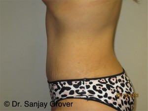 Tummy Tuck Before and After 95 | Grover Aesthetics