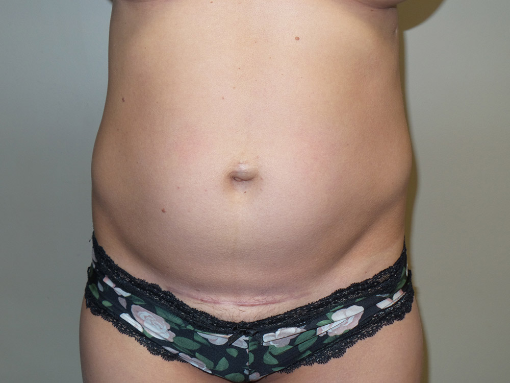 Tummy Tuck Before and After 73 | Sanjay Grover MD FACS
