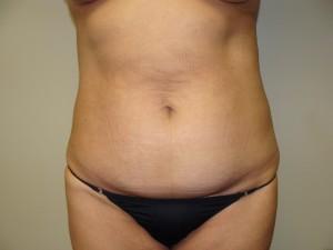 Tummy Tuck Before and After | Grover Aesthetics