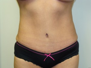 Tummy Tuck Before and After | Grover Aesthetics
