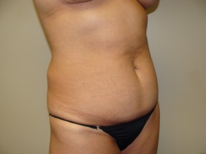 Tummy Tuck Before and After 96 | Sanjay Grover MD FACS