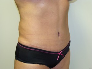 Tummy Tuck Before and After 96 | Sanjay Grover MD FACS