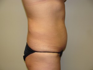 Tummy Tuck Before and After 96 | Sanjay Grover MD FACS