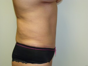 Tummy Tuck Before and After 96 | Sanjay Grover MD FACS