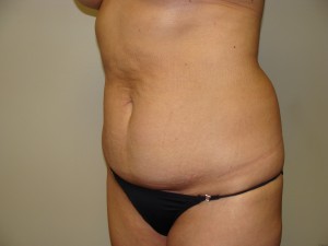 Tummy Tuck Before and After 96 | Sanjay Grover MD FACS