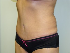 Tummy Tuck Before and After 96 | Sanjay Grover MD FACS