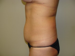 Tummy Tuck Before and After 96 | Grover Aesthetics