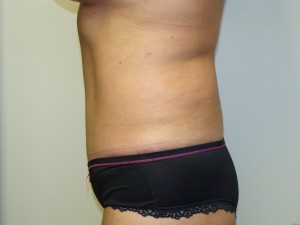 Tummy Tuck Before and After 96 | Sanjay Grover MD FACS