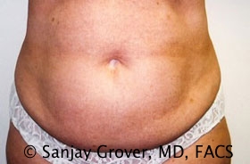 Tummy Tuck Before and After | Grover Aesthetics