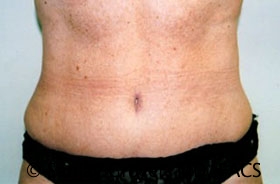Tummy Tuck Before and After | Grover Aesthetics