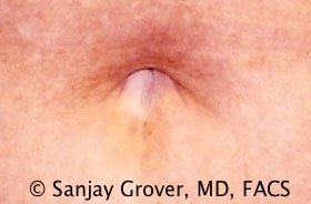 Tummy Tuck Before and After 97 | Sanjay Grover MD FACS