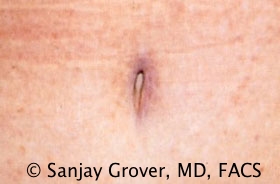 Tummy Tuck Before and After 97 | Grover Aesthetics