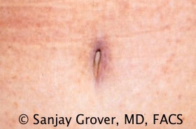 Tummy Tuck Before and After 97 | Sanjay Grover MD FACS