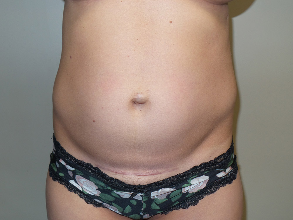 Tummy Tuck Before and After | Grover Aesthetics