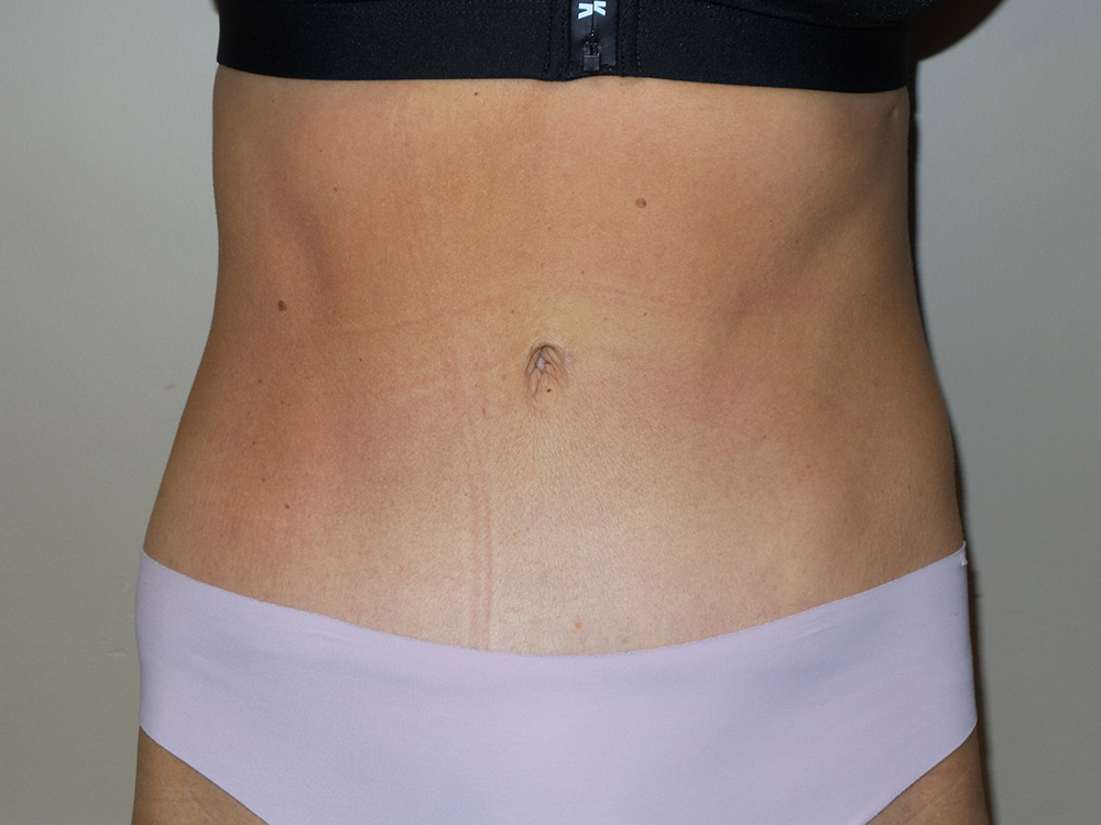 Tummy Tuck Before and After 98 | Sanjay Grover MD FACS