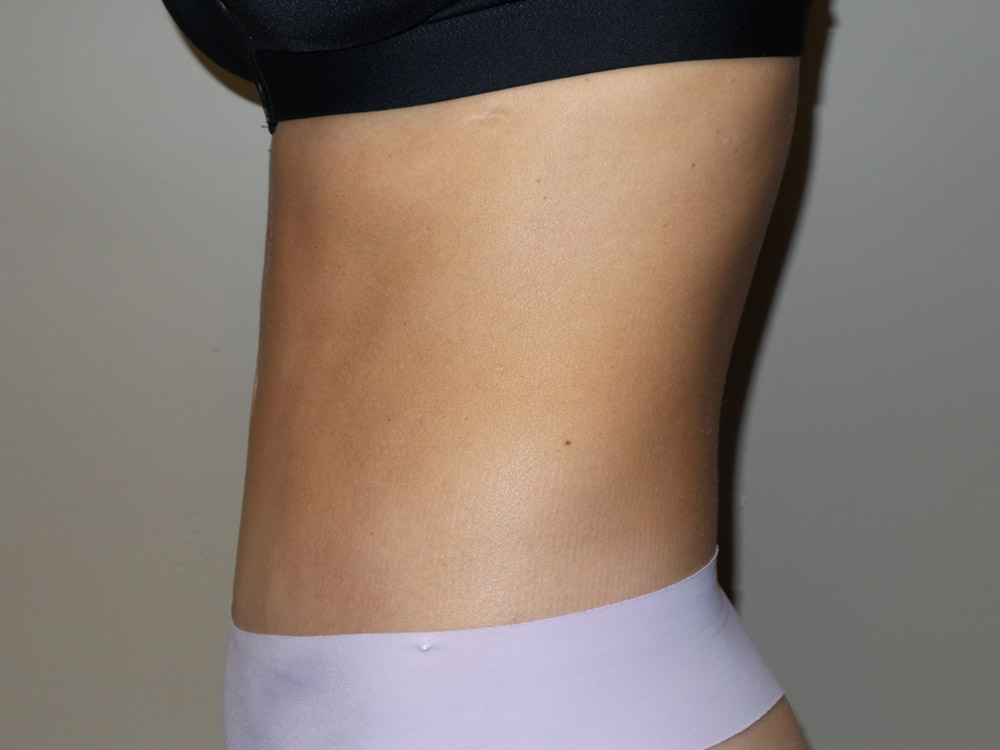 Tummy Tuck Before and After 98 | Grover Aesthetics