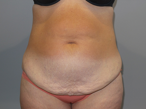Tummy Tuck Before and After 55 | Sanjay Grover MD FACS