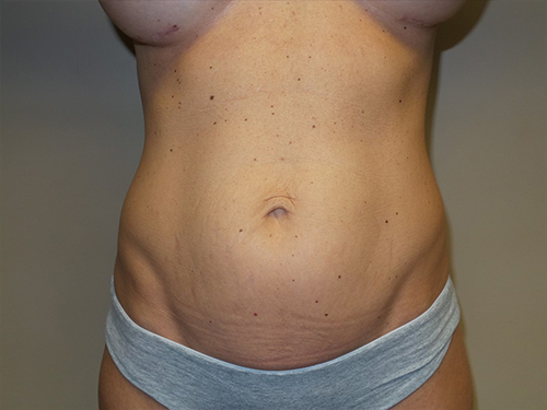Tummy Tuck Before and After | Grover Aesthetics