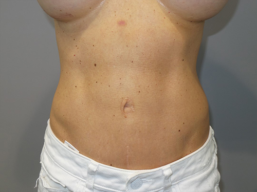 Tummy Tuck Before and After | Grover Aesthetics