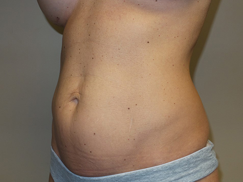 Tummy Tuck Before and After 99 | Sanjay Grover MD FACS