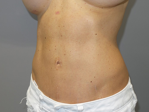 Tummy Tuck Before and After 99 | Grover Aesthetics