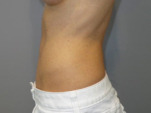 Tummy Tuck Before and After 99 | Grover Aesthetics