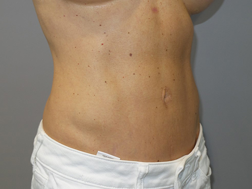 Tummy Tuck Before and After 99 | Grover Aesthetics